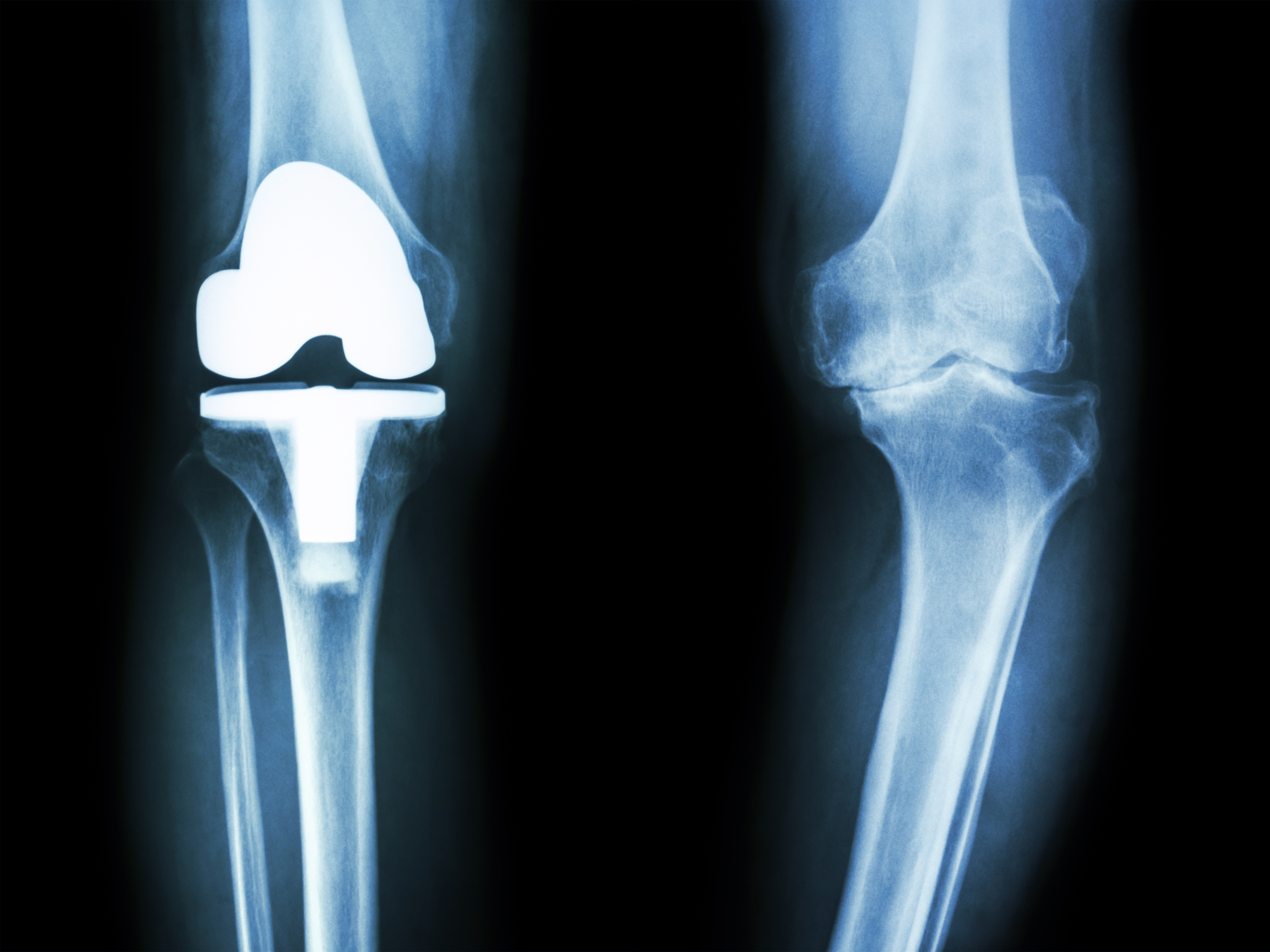 Preparation for Knee Surgery