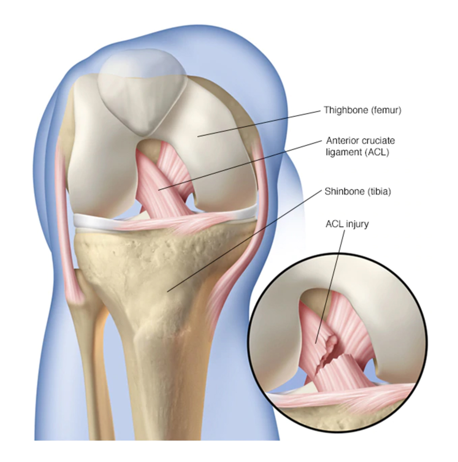 ACL Surgery