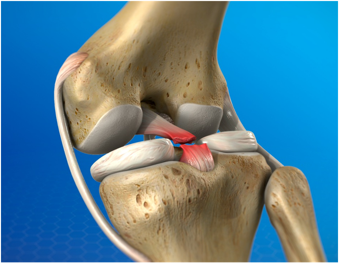 PCL Rehabilitation
