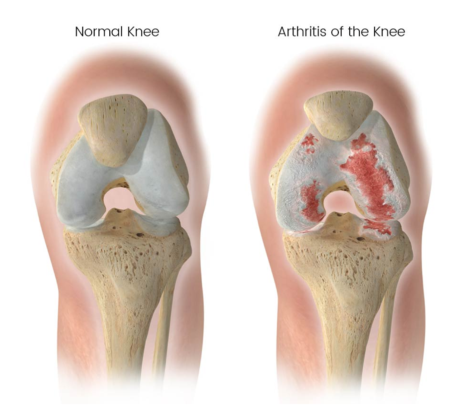 Knee Osteoarthritis