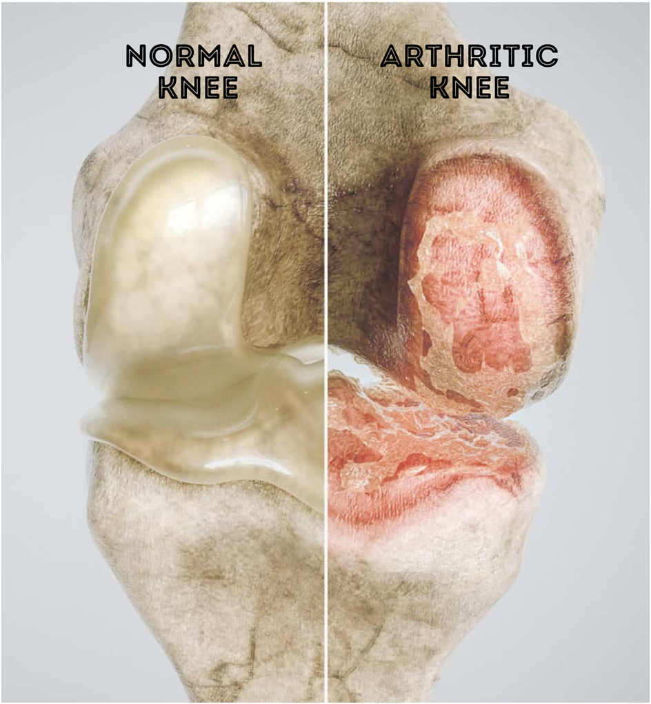 Causes of Knee Osteoarthritis