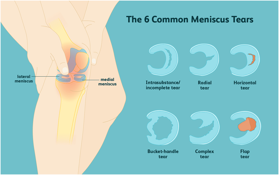 Causes of Rotator Cuff Tear