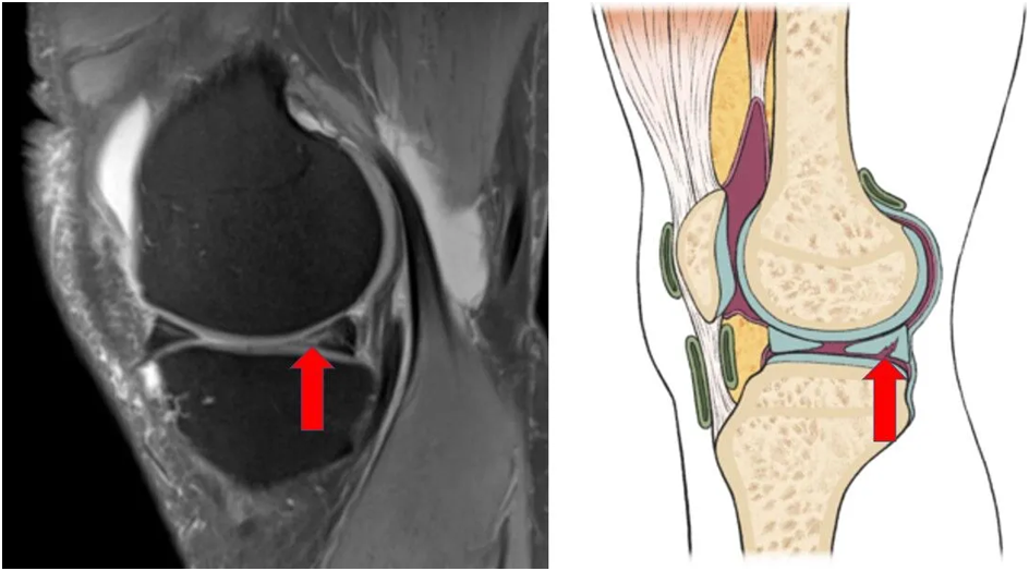 Causes of Meniscus Tear