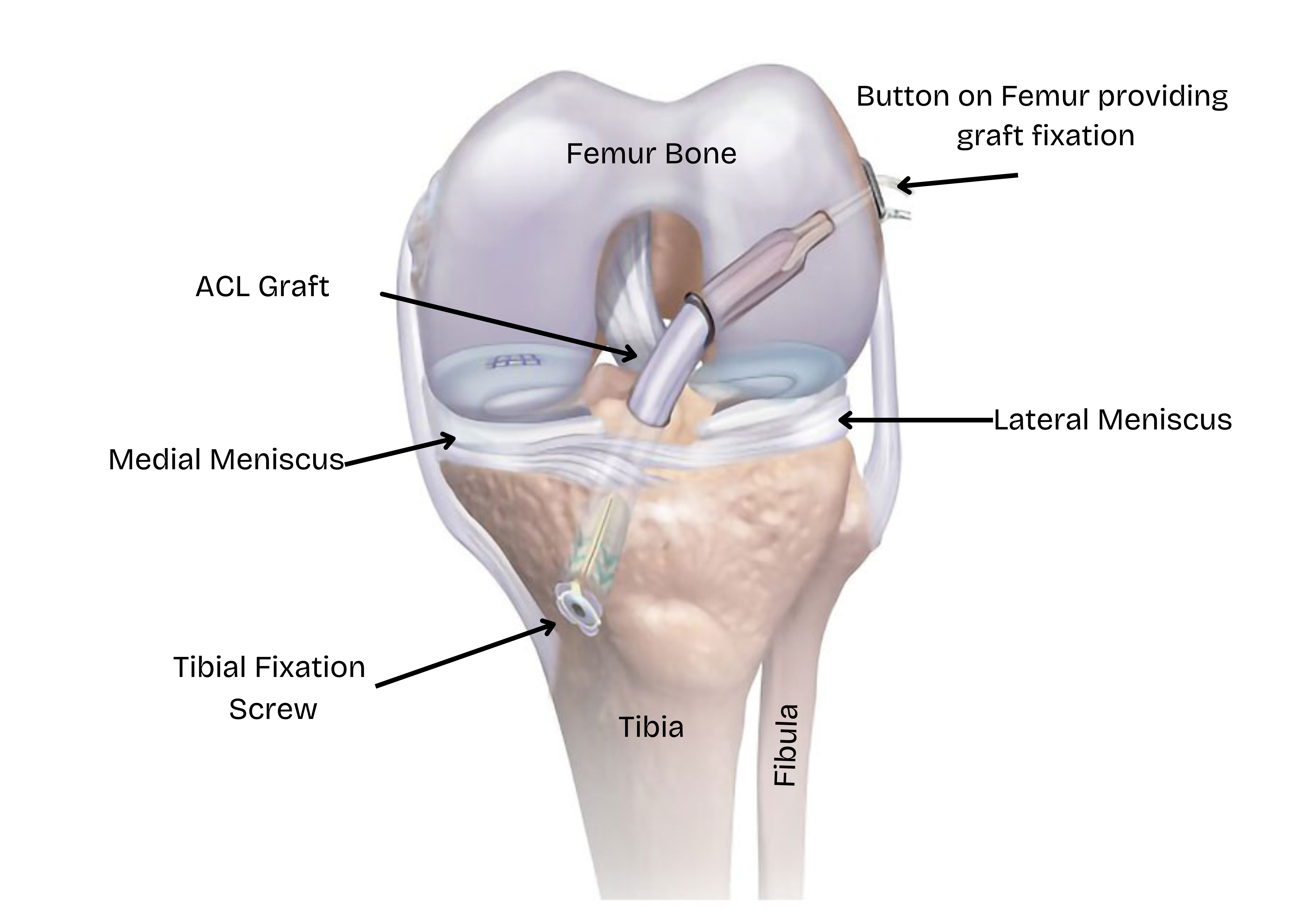 ACL Recovery