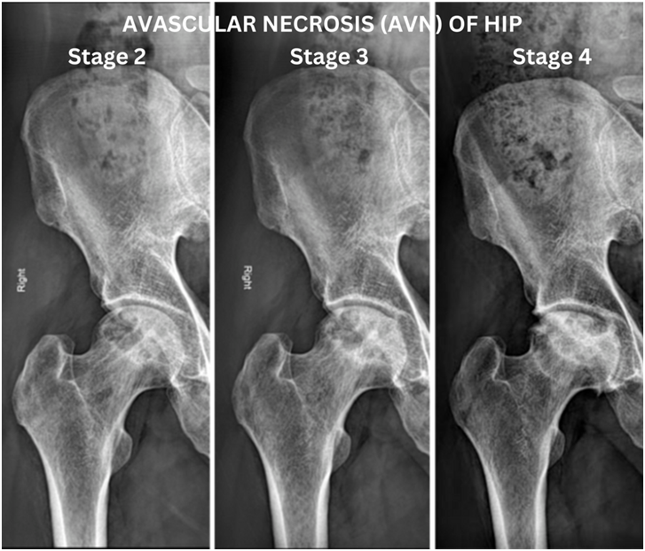 AVN Symptoms